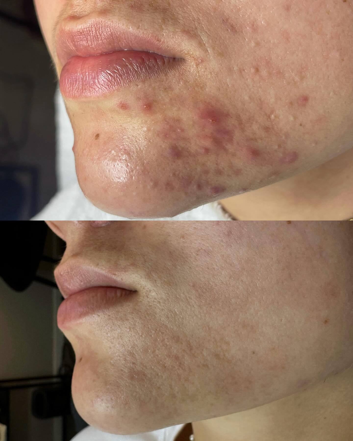 Voor en na: acne op de kin en een rustige huid na de behandelingen